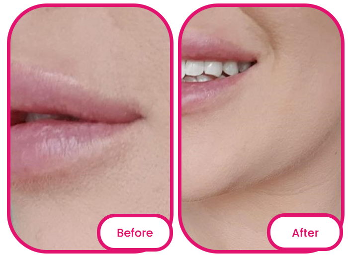 area around the lips before and after taking the best collagen gummies singapore