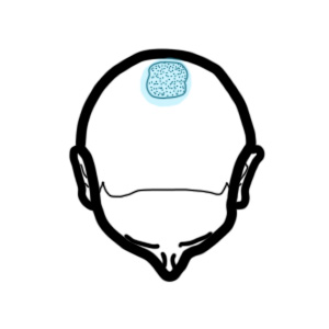 laser helmet for thinning crown, laser cap for thinning crown, laser hair growth helmet crown