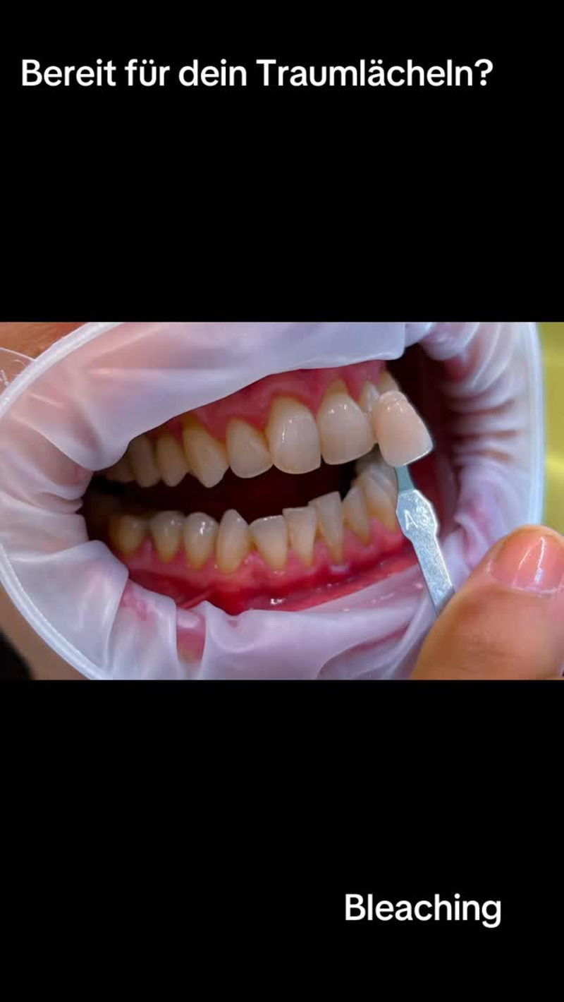 Du willst ein strahlendes Lächeln? ✨ Schau dir diese unglaubliche Verwandlung an! Von „Vorher“ zu „Nachher“ – das Ergebnis spricht für sich. Wer braucht nicht ein bisschen mehr Glanz im Leben? 😉 Bereit für dein eigenes Strahle-Lächeln? Kontaktiere un