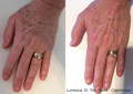 Woman's hand before and after Lumecca IPL for pigment