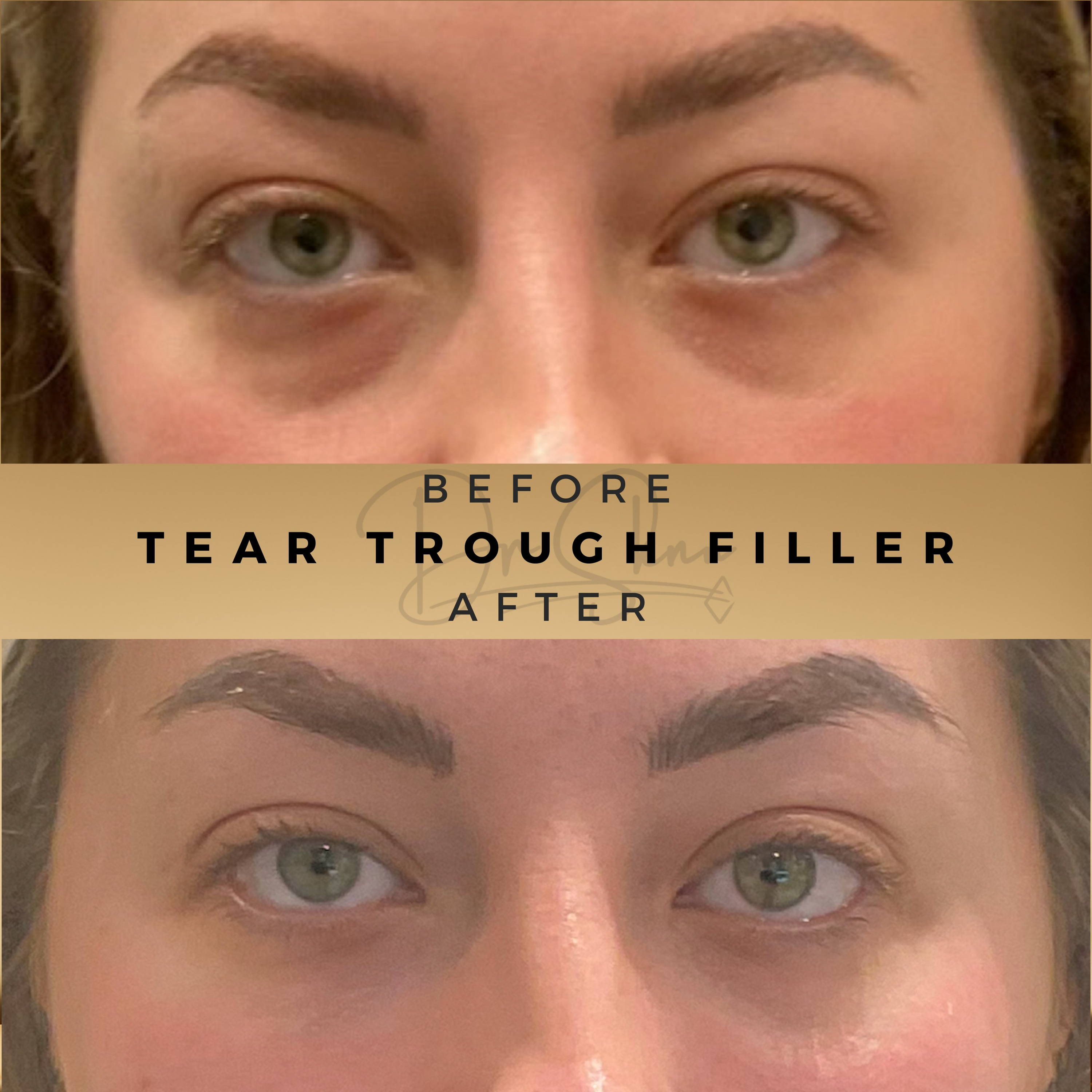 Tear Trough Fillers Wilmslow Before & After Dr Sknn