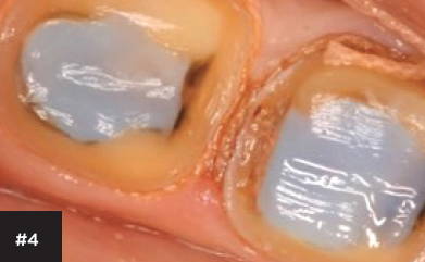 the remaining amalgam removed leaving the core material in place
