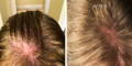 Nulastin-Scalp-Hair-Results-Before-After