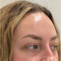 TEAR TROUGH FILLER BEFORE