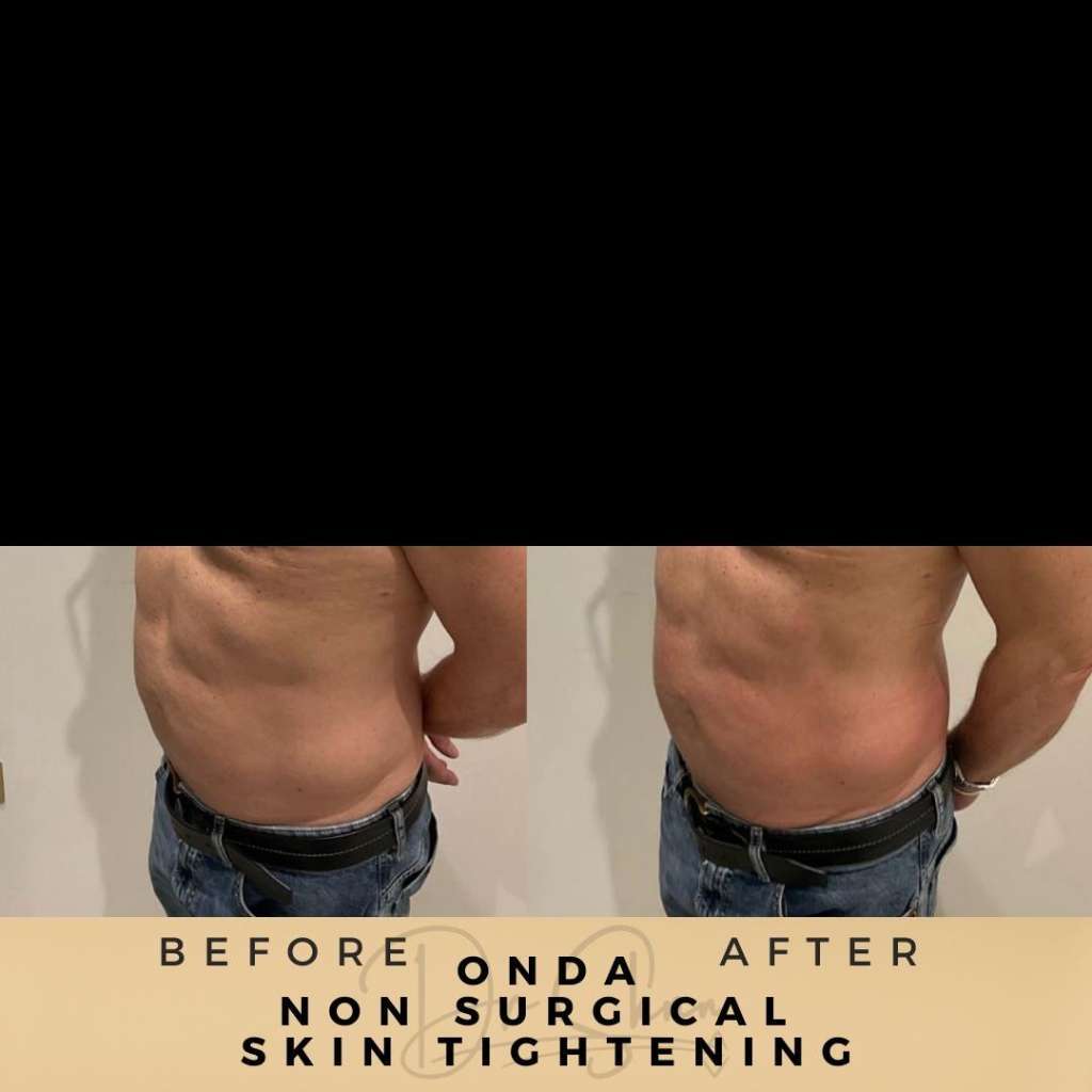 Skin Tightening Wilmslow Before & After Pictures Dr Sknn - Onda treatment
