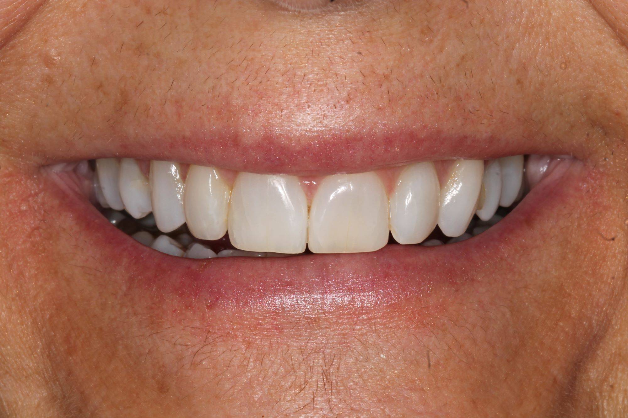 After procedure smile close-up