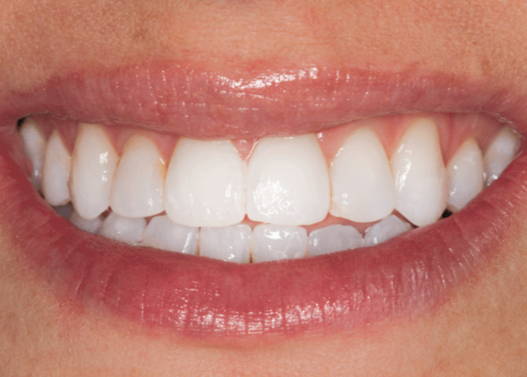 Smiling mouth after applying Enamelast Fluoride Varnish