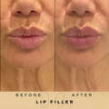 Lip Fillers Wilmslow with Anti-wrinkle injections