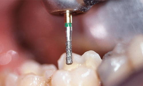 coarse diamond bur with Particle grit size: 151 microns