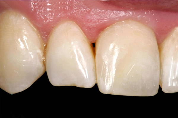 Deep Class IV Restoration: after the Bioclear Method