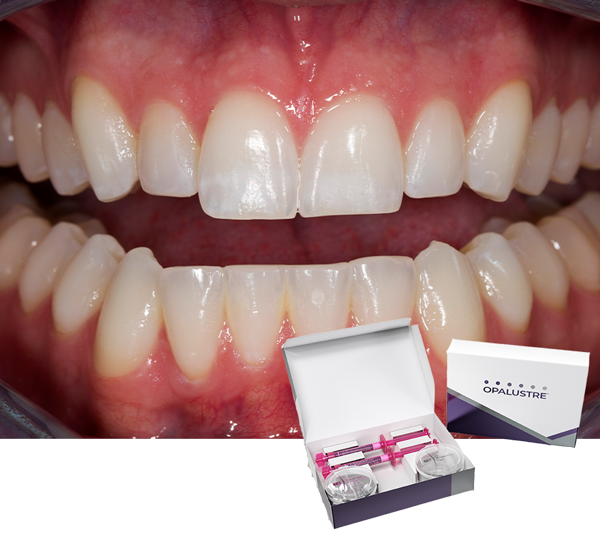 Opalescence teeth: after removing superficial white stains