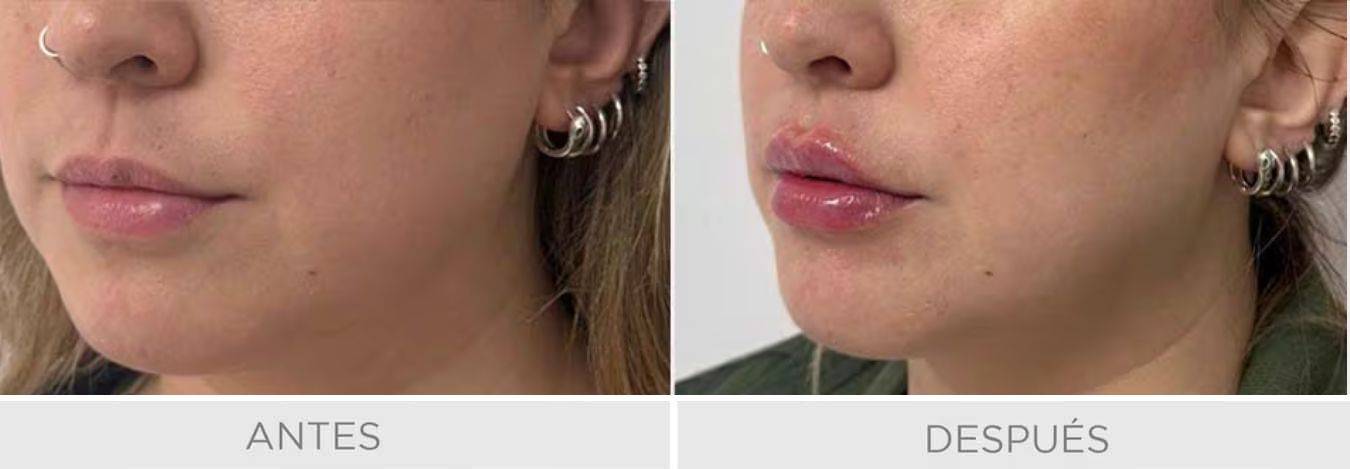 acido hialuronico labios