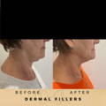 Marionette Line Filler Wilmslow Before & After Dr Sknn