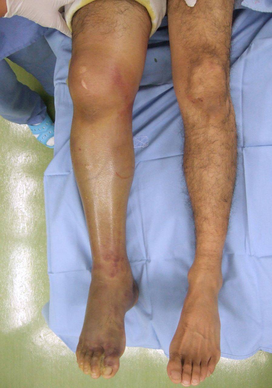 Chronic extertional compartment syndrome