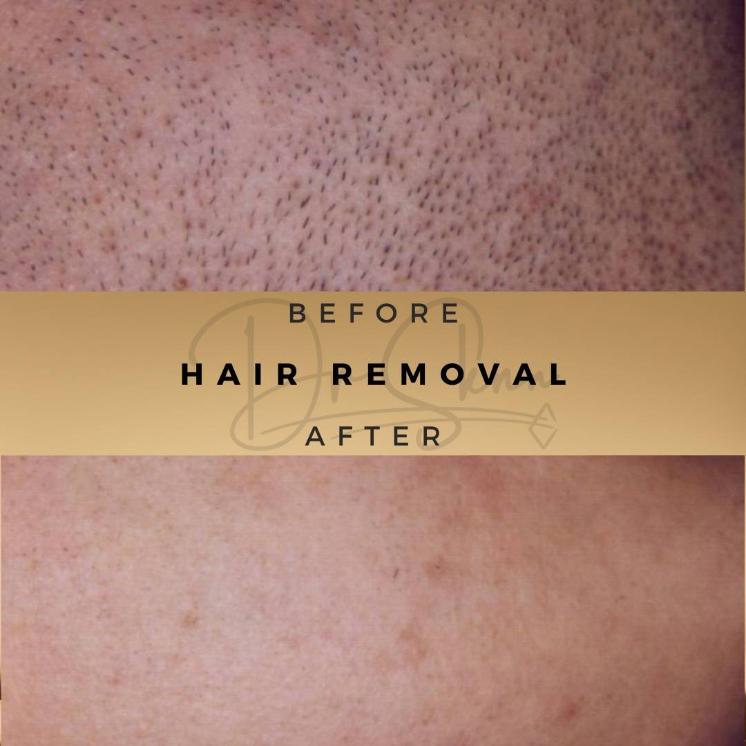 Laser Hair Removal Wilmslow Before & After Dr Sknn