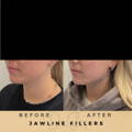 Jaw Fillers Wilmslow Before & After Dr Sknn