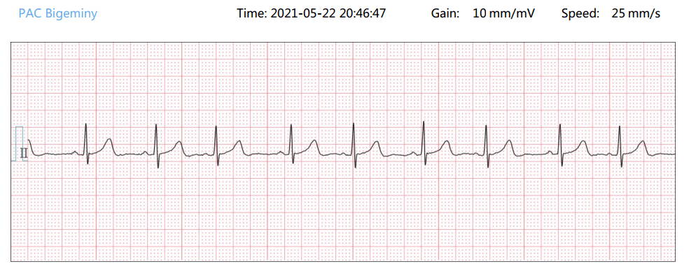 Forma de onda de ECG del pareado de PAC Bigeminy