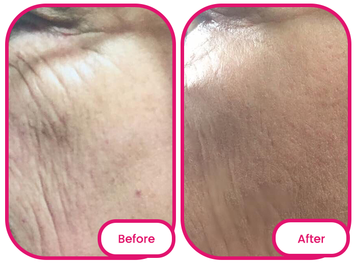 skin before and after taking the best collagen gummies singapore