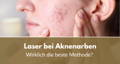 laser bei aknenarben