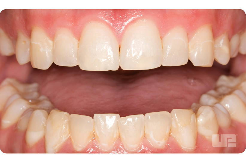 Opalescence teeth: before