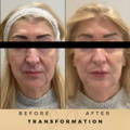Cheek Fillers Wilmslow