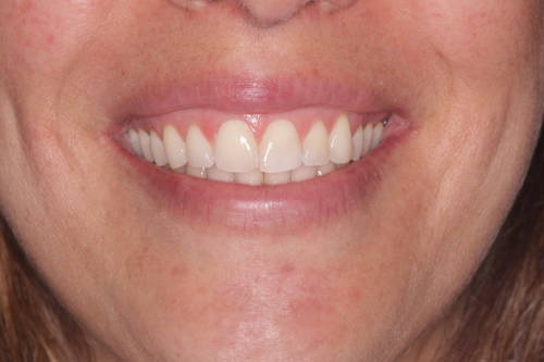 Female smiling after whitening treatment