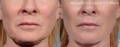 Woman's sagging jawline before and after Morpheus8
