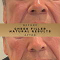 Cheek Fillers Wilmslow