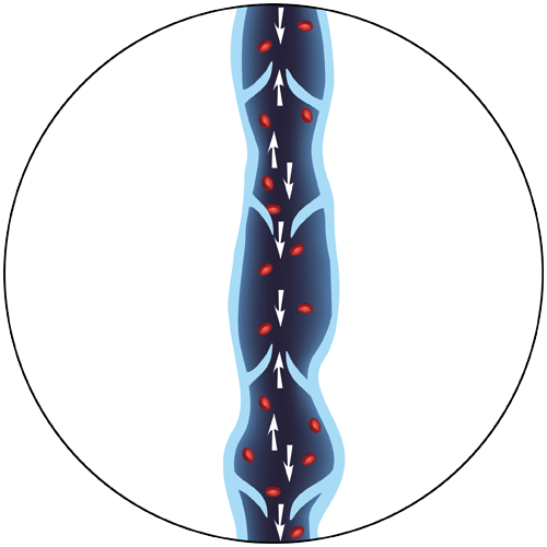 Diseased Vein Illustration