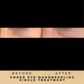 NCTF135 Under Eyes Before & After Wilmslow, Cheshire Dr Sknn Aesthetic