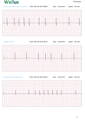 fragmento de electrocardiograma/electrocardiograma