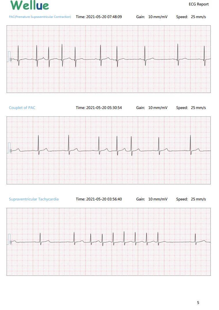 fragmento de electrocardiograma/electrocardiograma