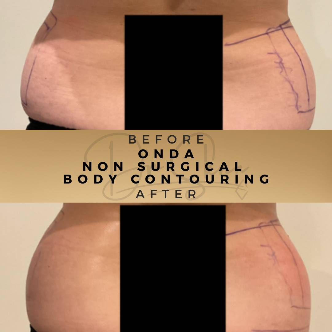 Body Contouring - Non-surgical - Dr Sknn before and after