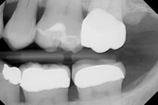 X-Ray shows the margins seated completely before cementation