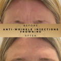 Number 11s Anti-Wrinkle Injections Wilmslow Dr Sknn Before & After Picture