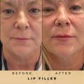 Perioral Line Fillers Wilmslow Before & After