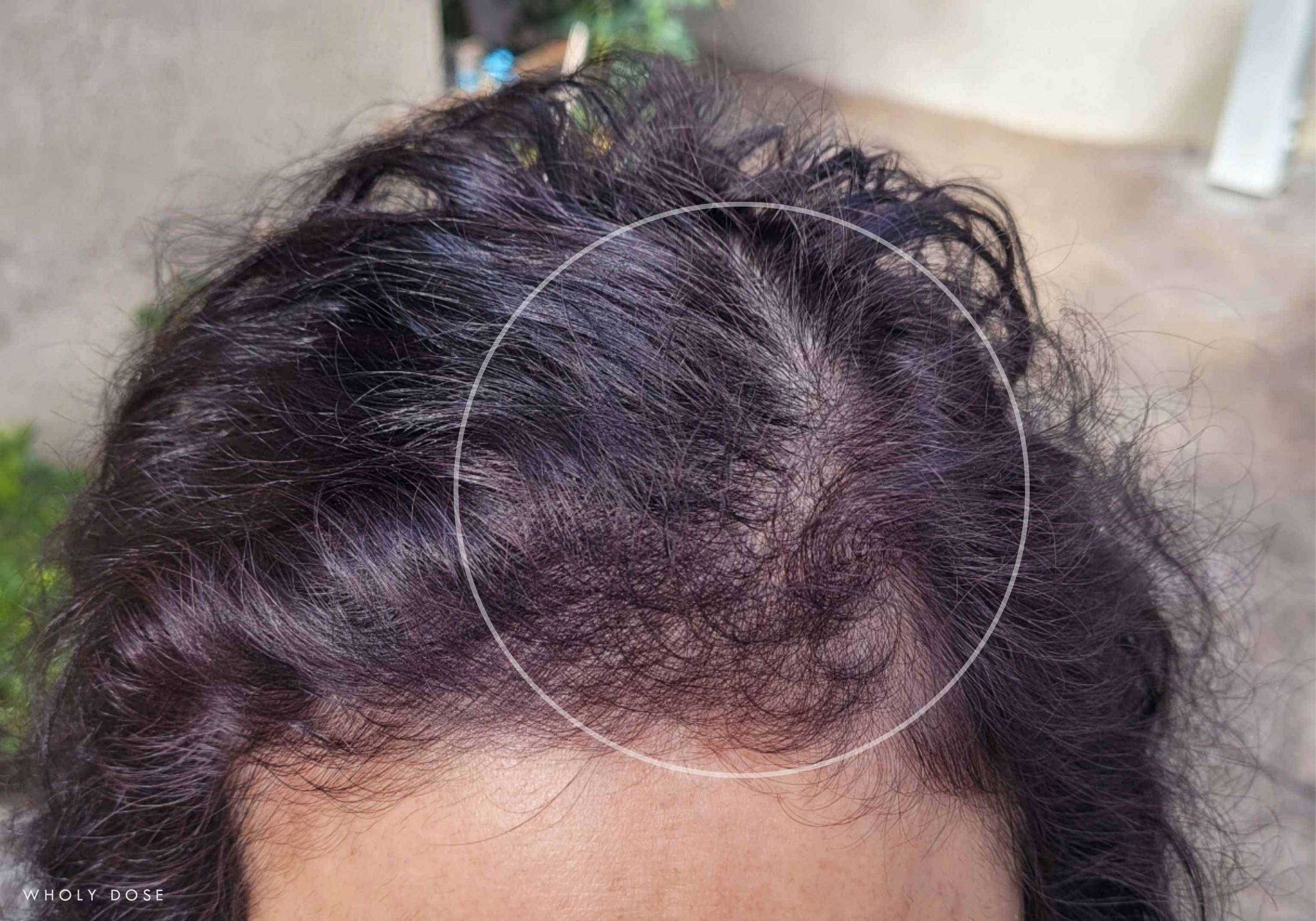 collagen-before-after-pictures-hair-growth-loss