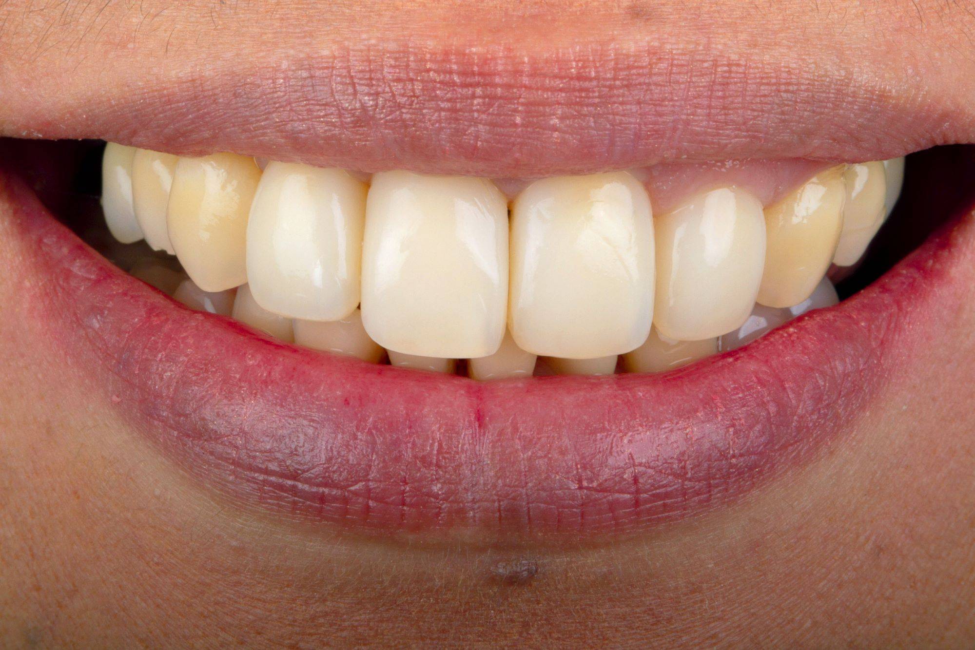 Close-up in smile after final treatment