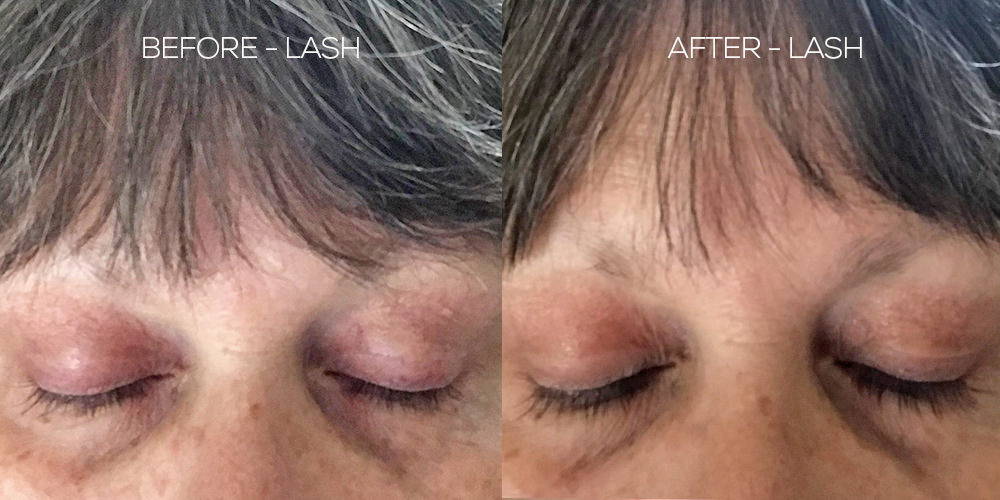 Before and After Results Using LASH Follicle Fortifying Serum with Keracyte® Elastin Complex