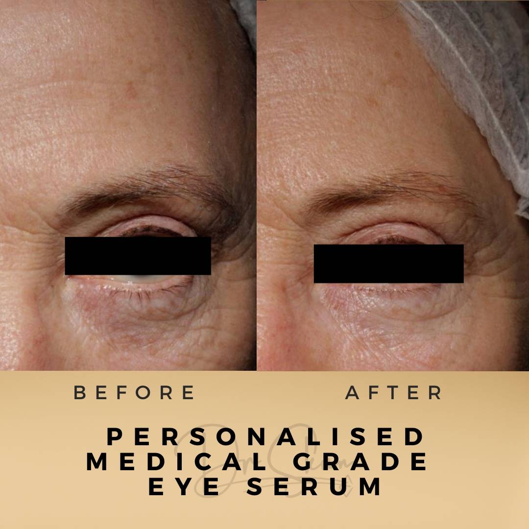 Under Eye Wrinkle Treatment Wilmslow Before & After Dr Sknn