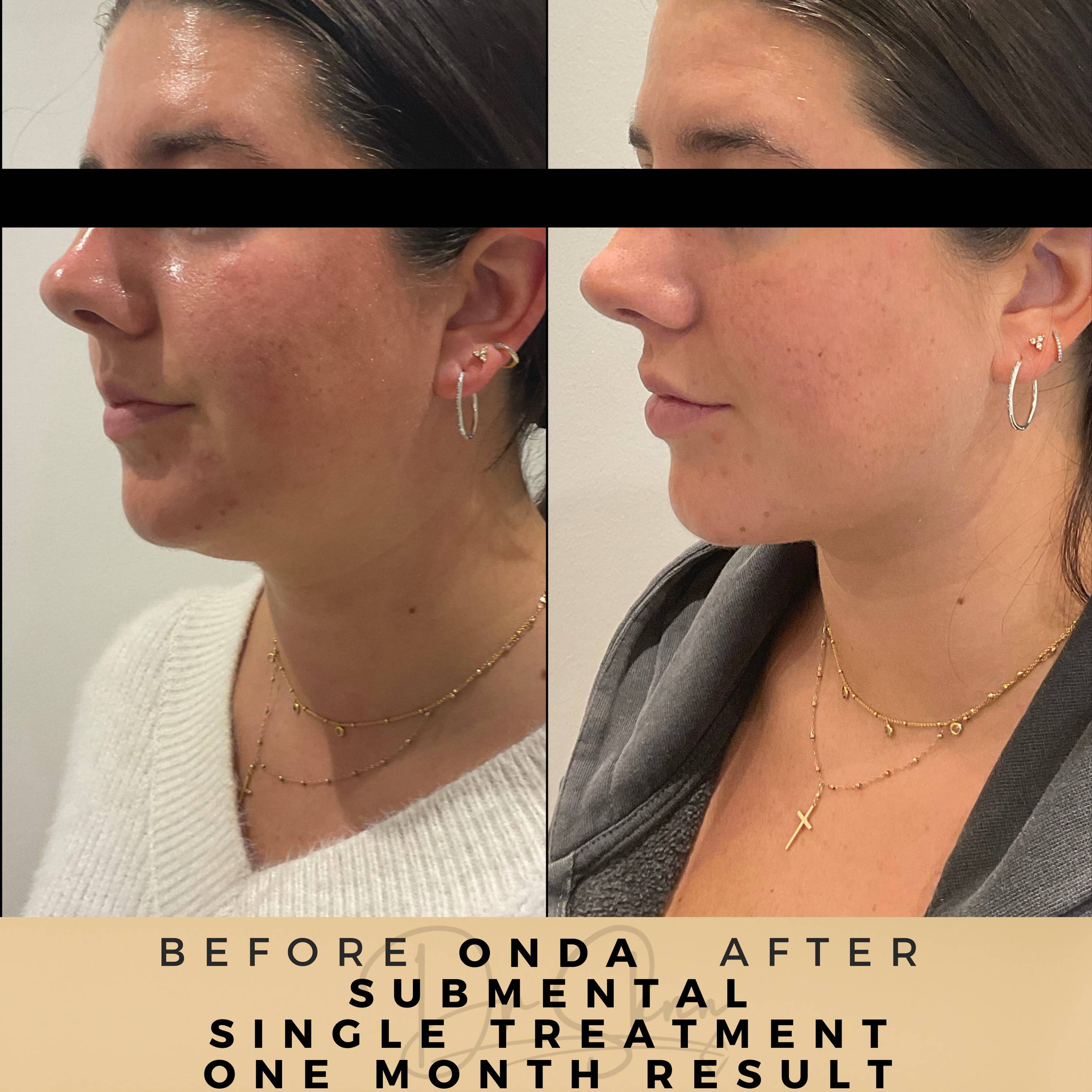 Fat Reduction - Non-surgical - Dr Sknn before and after