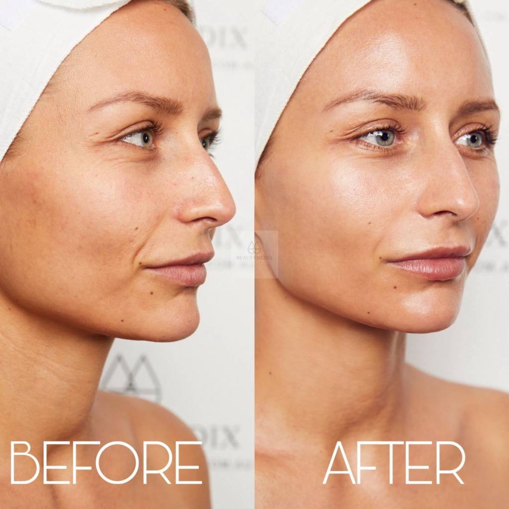 BEFORE & AFTERS - BODY SCULPTING – BEAUTYMEDIX