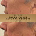 Cheek Fillers Wilmslow