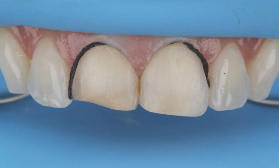 Ultrapak placed into teeth