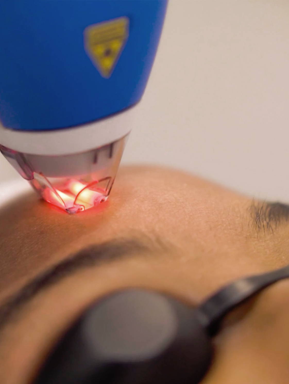 Laseraway Clear And Brilliant Cost