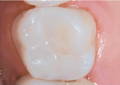 molar after restoration with Evanesce Silk