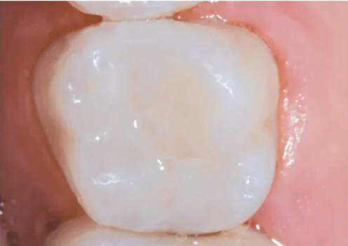 molar after restoration with Evanesce Silk