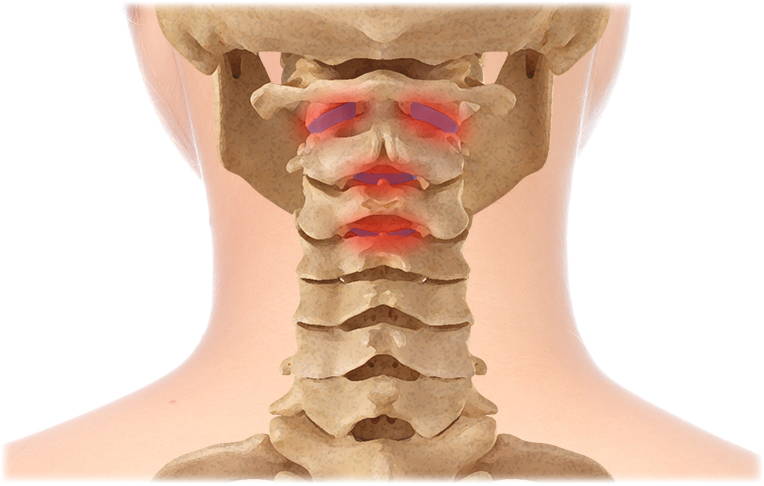 Herniated Disc Illustration