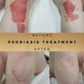 Psoriasis Treatment Wilmslow Dr Sknn Before & After Picture