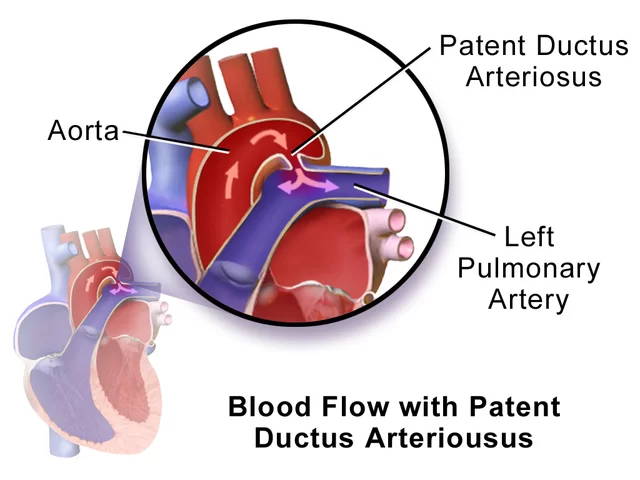patent ductus arteriosus chipit